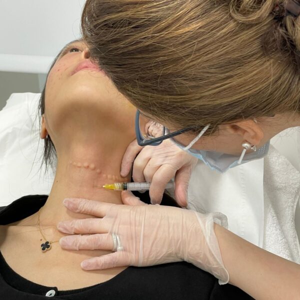 PRP (Platelet Rich Plasma) Injection In Neck